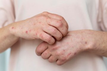 Panjang Waspada Penyakit Zoonosis: Mpox Ditetapkan Kembali sebagai Darurat Kesehatan Global